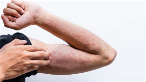 Hives and Rashes: An Overview of Two Skin Reactions