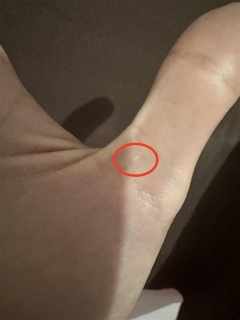 Tiny clear bumps on my hands : r/SkincareAddicts