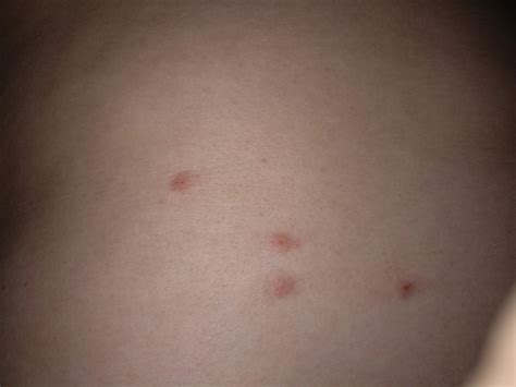 Flohstiche, lieg ich richtig? (Gesundheit und Medizin, Medizin, Körper)