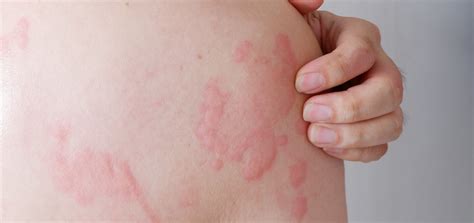 Hives Skin Rashes Itchy