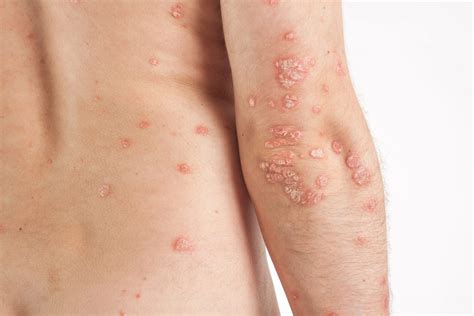 Apa Itu Penyakit Psoriasis - Homecare24