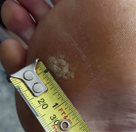 Is my wart gone? : r/Warts