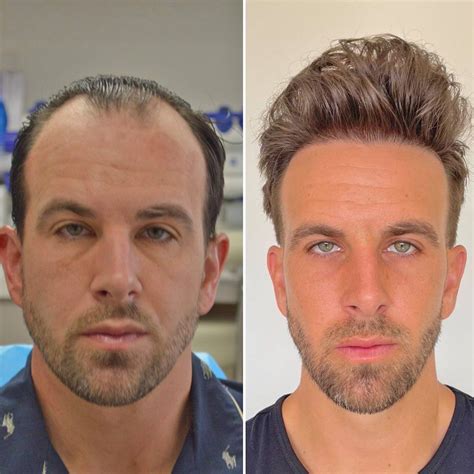 Hair Transplant Before And After