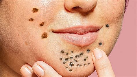 Unbelievable Blackhead Removal 2024: The Ultimate Guide to Poreless Skin - f8kxwi9