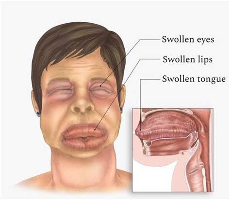 Angioedema - MEDizzy