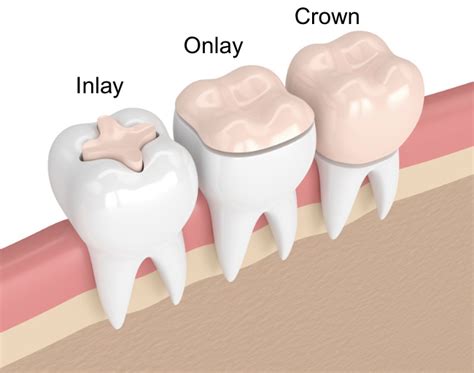 Dental Inlays vs Dental Onlays vs Dental Crowns | Dr. Jose-Luis Ruiz