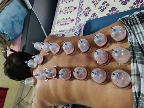 aci vacuum cupping therapy products mujtaba hijama cupping therapy