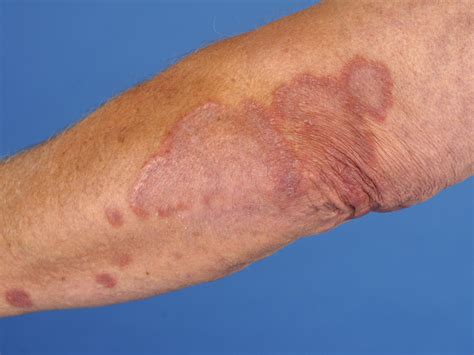 Granuloma Anular Generalizado Da Face