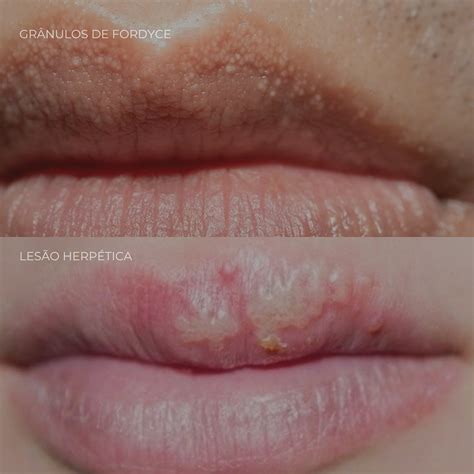 Micro Bolhas Nos Labios - Bolhas Brancas Nos Labios Lábios. Lábios Vermelhos. Boca Feminina