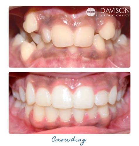 Common Treatments - Davison Orthodontics