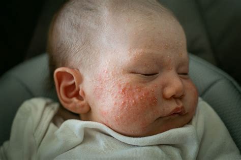 Acne Neonatal Quanto Tempo Dura - Acne neonatal: quanto tempo dura e tratamento - Minha Vida