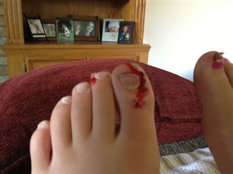 Sore Toes After Running Long Distance at Juan Maguire blog