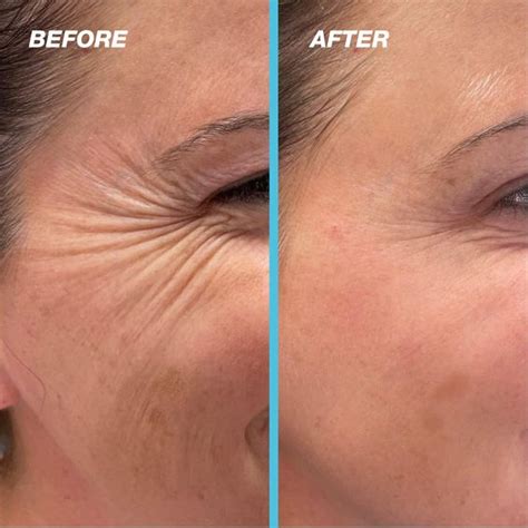 NCTF 135 HA Injections: Ultimate Guide to Skin Rejuvenation