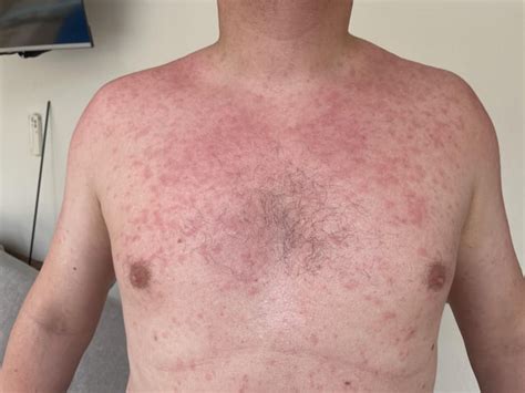 Prickly heat : r/Dermatology