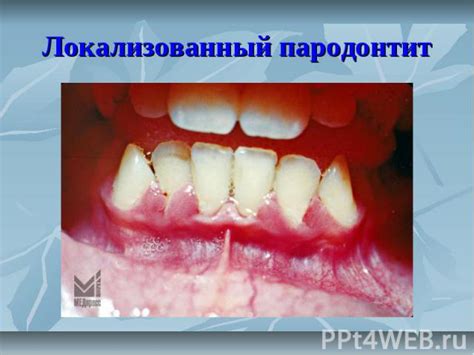 Локализованный пародонтит фото