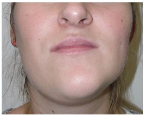 unilateral condylar hyperplasia  surgeons perspective  narrative review