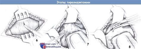 Этапы и техника удаления щитовидной железы (тиреоидэктомии)
