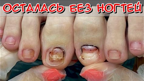 Осталась без ногтей / Ушибла ноготь / гематома под ногтем / Зачистка ...