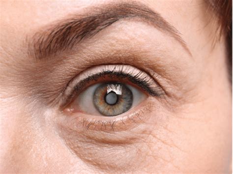 Cataract