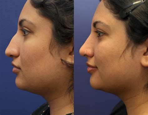 patient  rhinoplasty gallery tansavatdi facial plastic surgery