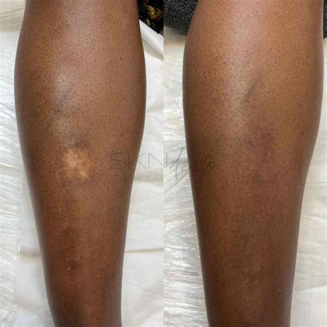 Scar Camouflage Specialists | SKN Deep Cosmetic Clinic, Grimsby ON ...