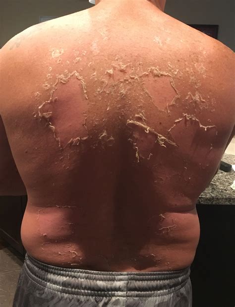 997 best r/peeling images on Pholder | Words cannot explain how much I