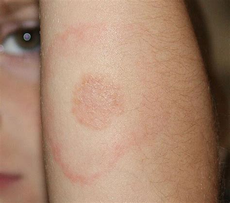 Lyme Disease Rash Photos: Early-Stage, Bull’s-Eye, and Atypical Rashes ...