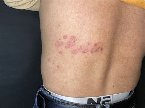 painless plaques      bmj
