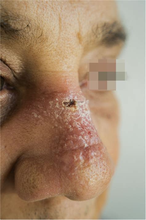 Successful treatment of diffuse cutaneous leishmaniasis caused by ...