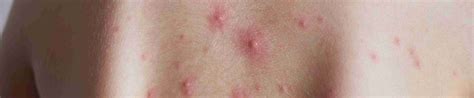 Paano makaiwas sa Bulutong o Chickenpox? | Mediko.PH