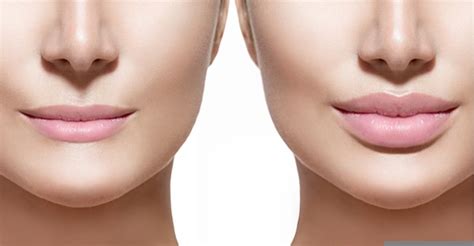 Lip Enhancement Surgery | Dr. Karol Gutowski | Lip Lift Chicago