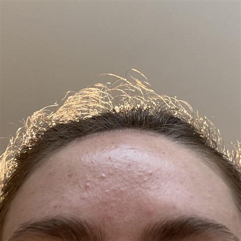 Tret help: Is my retrieve cream causing irritation?? : r/tretinoin