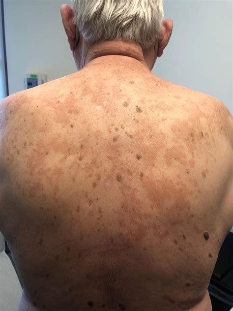 Fungal Skin Rash On Back