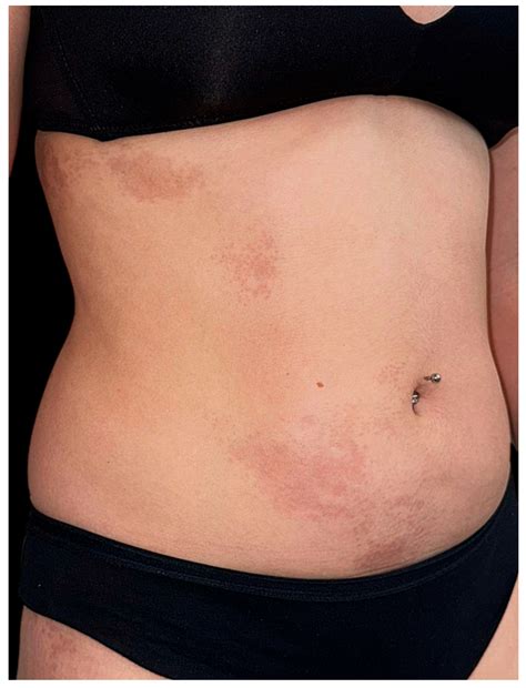 Linear Atrophoderma of Moulin: A Rare Blaschkoid Dermatosis