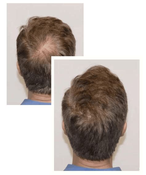 Alma TED Treatment – HCI Hair solutions