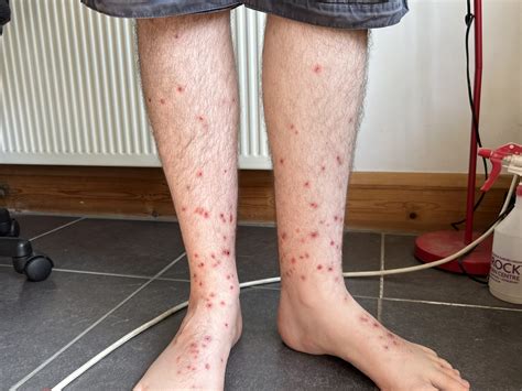 Bed Bug Bites On Legs Only