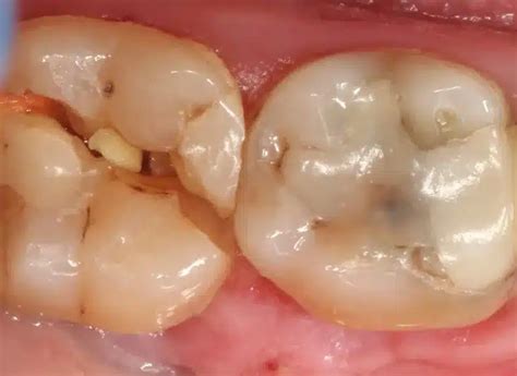 Dente Quebrado Tem Como Restaurar - Meu Dente Quebrou. E Agora? Soluções para Restauração e Recuperação do ...