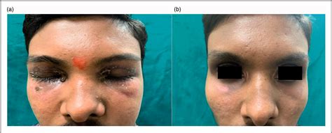 figure   bilateral periorbital oedema revealed  systemic lupus