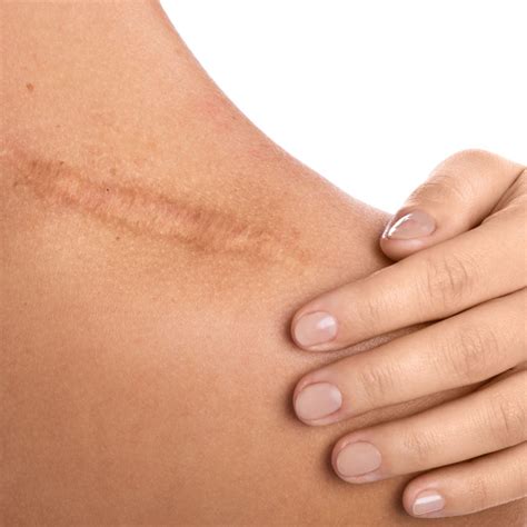 scar removal naweta aesthetics