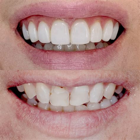 Composite Bonding Gallery Essex Dentist