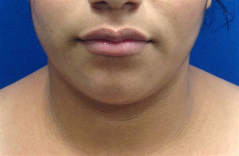 chin neck ideal face  body