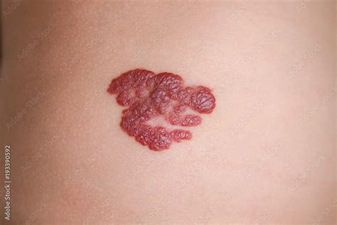 Infantile Hemangioma red birthmark (also called strawberry mark) on the baby's belly. Infantile ...