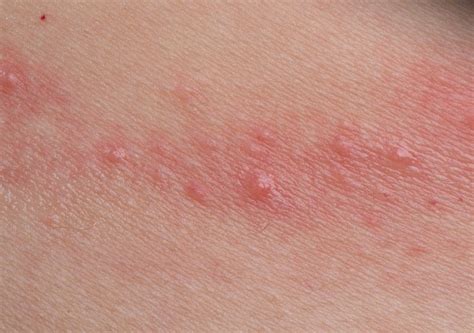 Thinkbaby sunscreen contact dermatitis - gertylosangeles