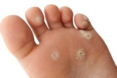 Plantar Wart Laser Treatment