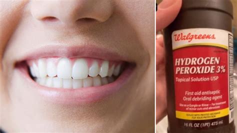 Baking soda and Hydrogen Peroxide teeth whitening - #1 DENTIST IN ...