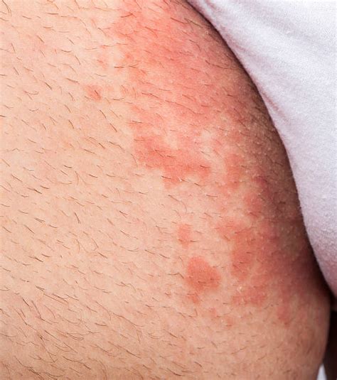 groin rash stock  pictures royalty  images istock