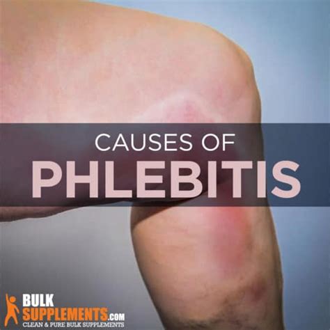 phlebitis symptoms  treatment