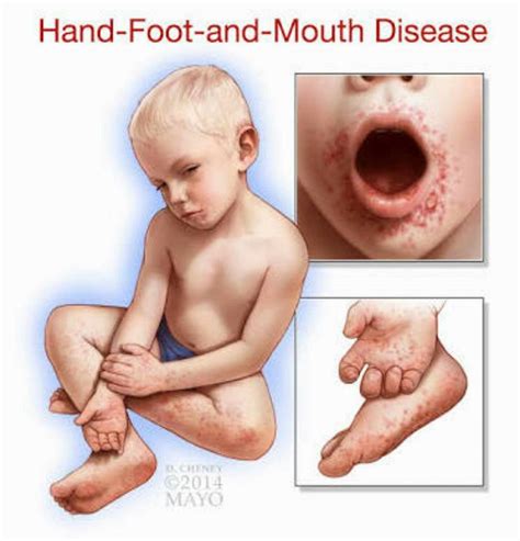 Hand voet en mond siekte is... - Dr Rufus Nortjé & Associates | Facebook