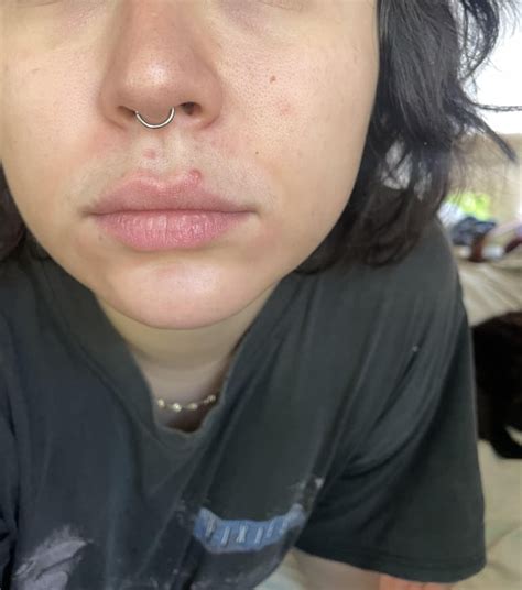 27F breaking out around mouth constantly after never having skin issues ...