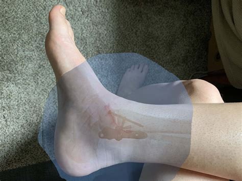 Trimalleolar Ankle Fracture Healing — Part 2 — Rewild Mothers